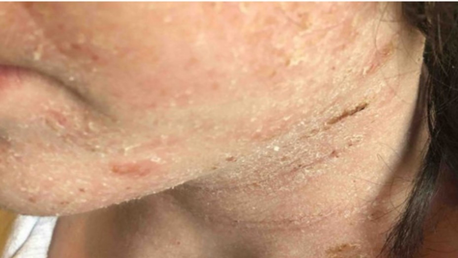 Tiene 14 años, sufre un eccema muy grave y pide entrar en coma porque ya no aguanta el dolor