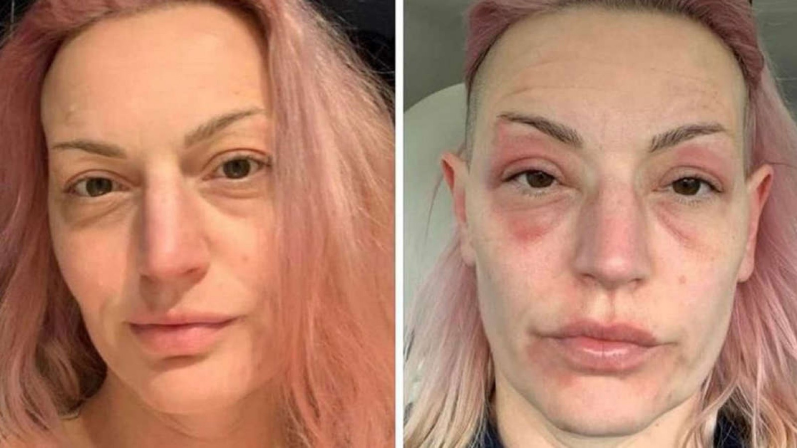 Asegura que envejeció "20 años en tres días" luego de recibir la vacuna Pfizer