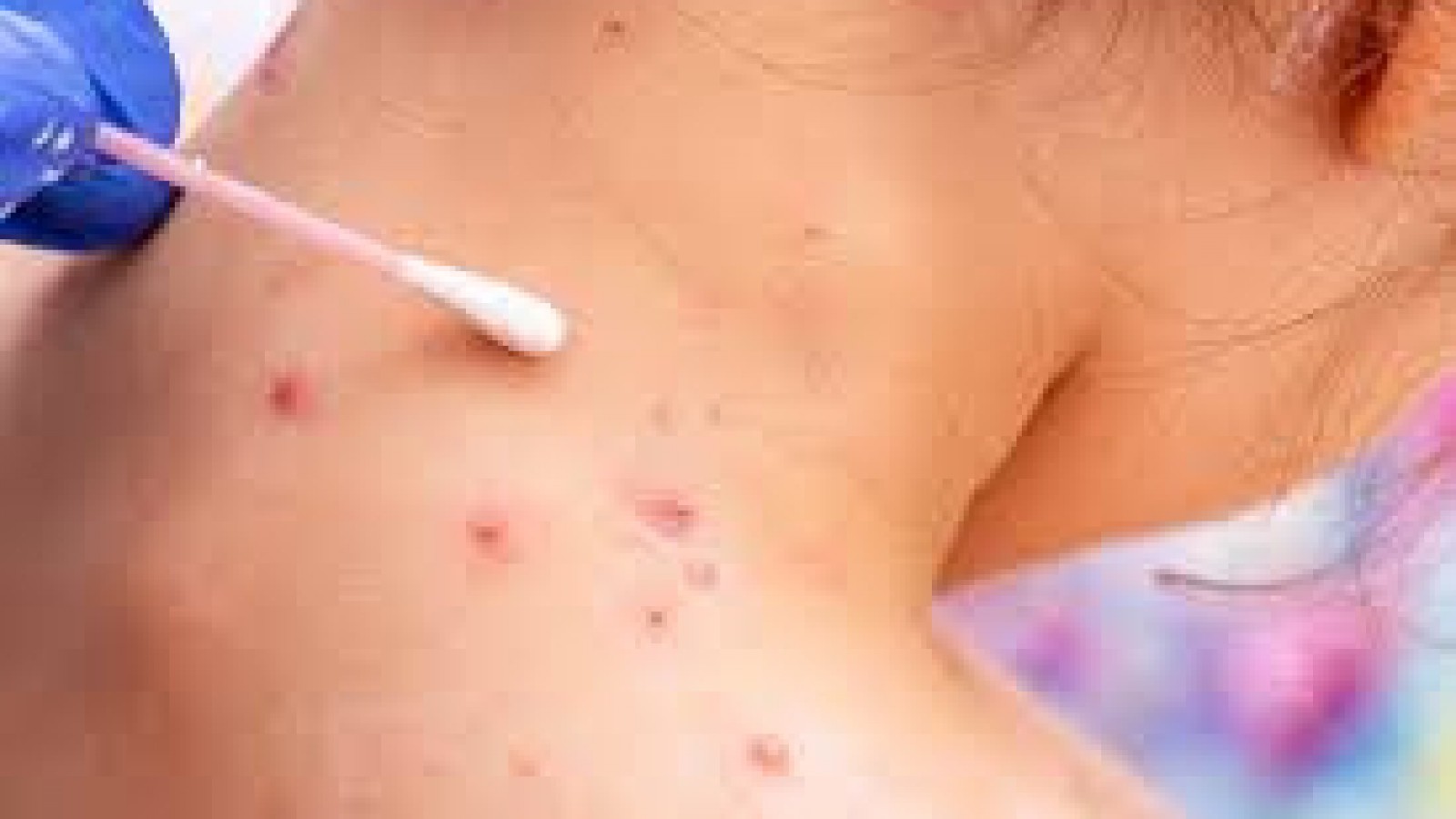 Alerta mundial por la aparición de la viruela del mono