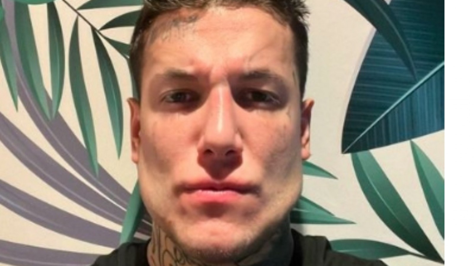 La nueva cara de Alex Caniggia tras agrandarse la mandíbula